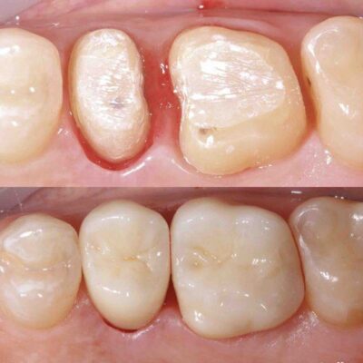лечение кариеса зубов спб